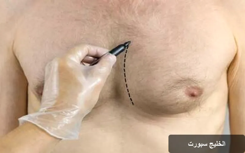 التثدي عند الرجال: خطر غير مرئي يهدد الصحة ويضاعف احتمالية الإصابة بالسرطان