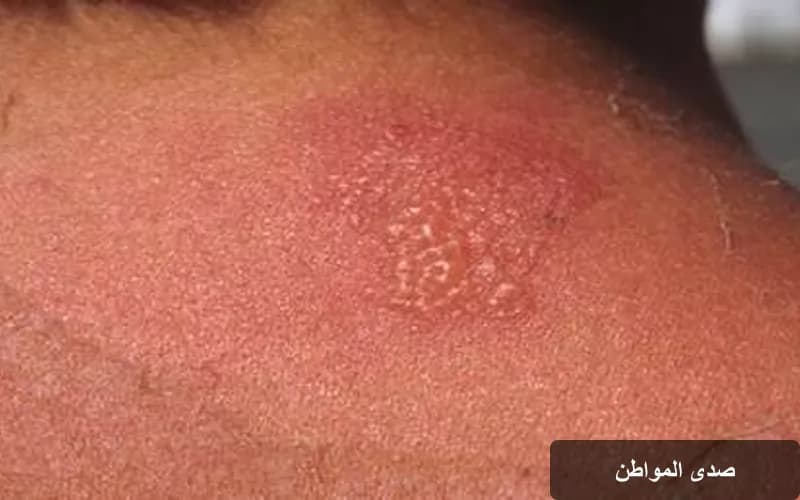 حروق الشمس وتأثيراتها الخفية: كيف تؤثر على المناعة والخلايا